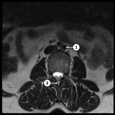 MR lumbar spine axial - labelling questions | Radiology Case ...