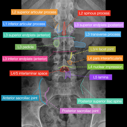 Normal Cervical Spine Radiographs Image Radiopaediaorg