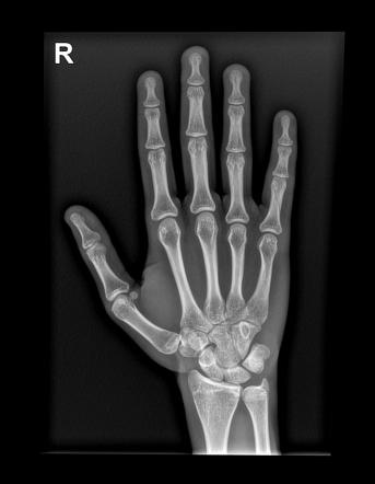 Proximal Phalanx Fracture 