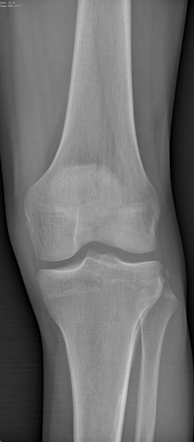 Segond fracture | Radiology Case | Radiopaedia.org