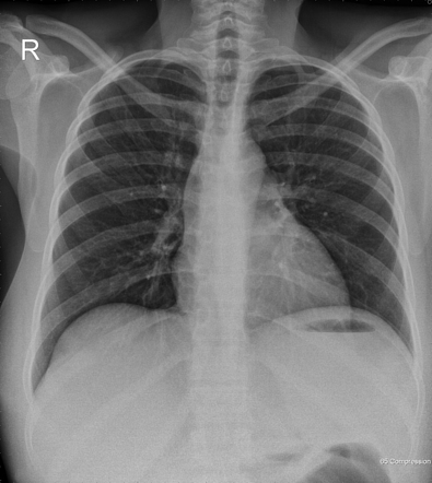 Delayed complications following uterine artery embolization | Radiology ...