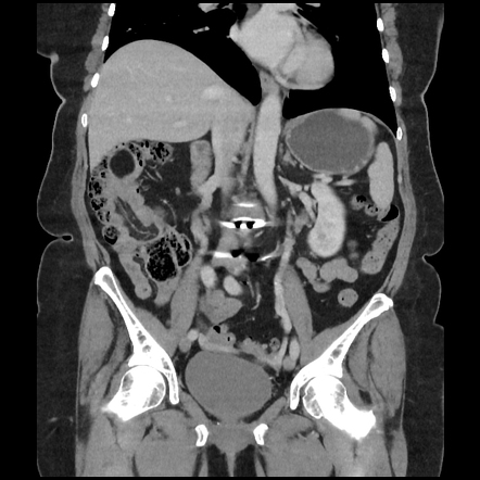 Ileocolic intussusception - lipoma lead-point | Radiology Case ...