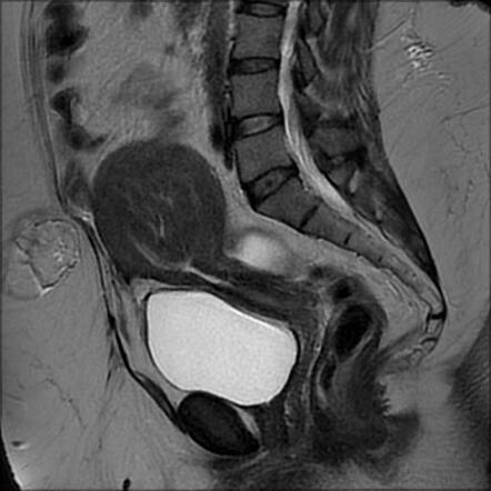 Submucosal uterine leiomyoma | Radiology Case | Radiopaedia.org