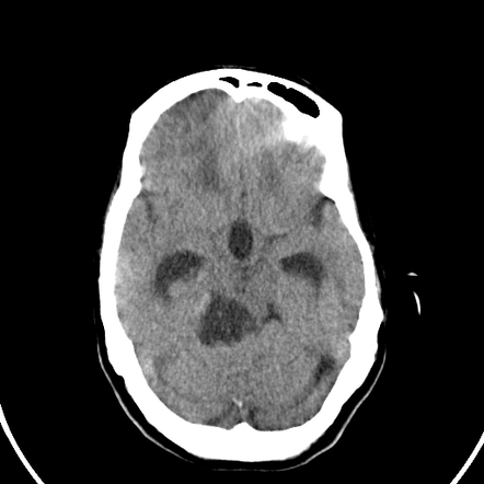 Epidermoid Cyst 