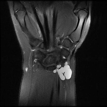 Ganglion Cyst - Wrist | Radiology Case | Radiopaedia.org