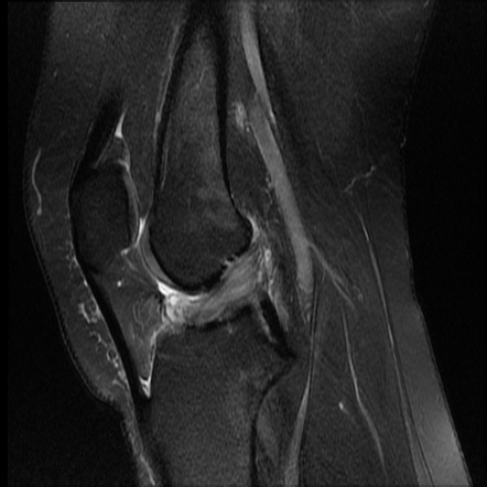 ACL mucoid degeneration associated with ganglion cysts | Radiology Case ...