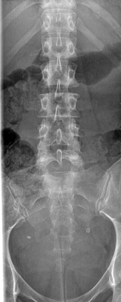 Tubal ligation (Falope ring) | Radiology Case | Radiopaedia.org