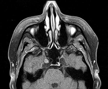 Meckel cave meningioma | Radiology Case | Radiopaedia.org