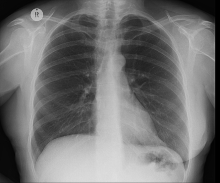 Mastectomy (CXR) | Radiology Case | Radiopaedia.org