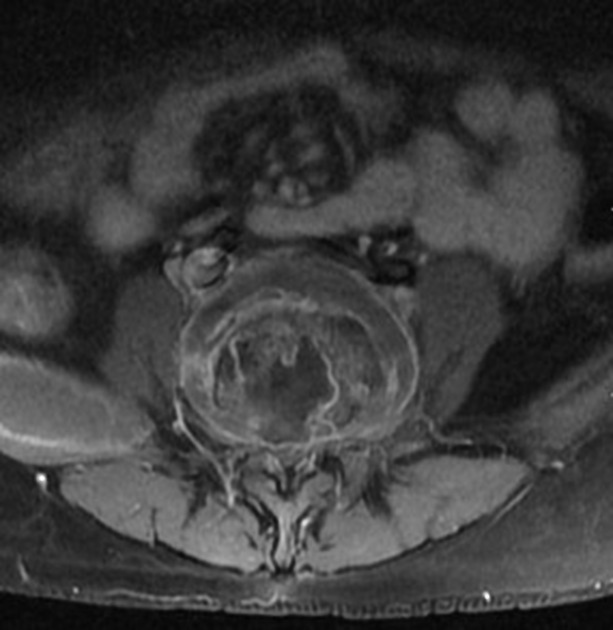 Spondylodiscitis | Radiology Reference Article | Radiopaedia.org