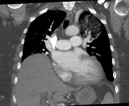 Alveolar Hemorrhage And Possible Lymphocytic Interstitial Pneumonitis 