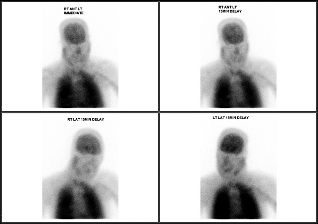 Negative nuclear medicine brain death scan | Radiology Case 