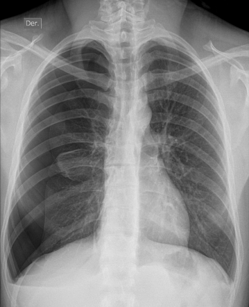 Spontaneous pneumothorax | Radiology Case | Radiopaedia.org