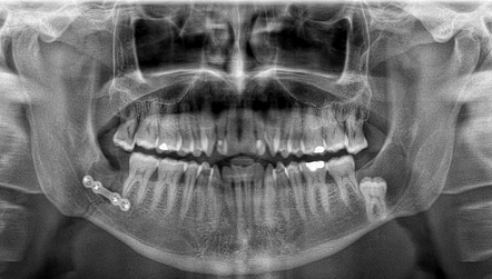 Dentigerous cyst | Radiology Case | Radiopaedia.org