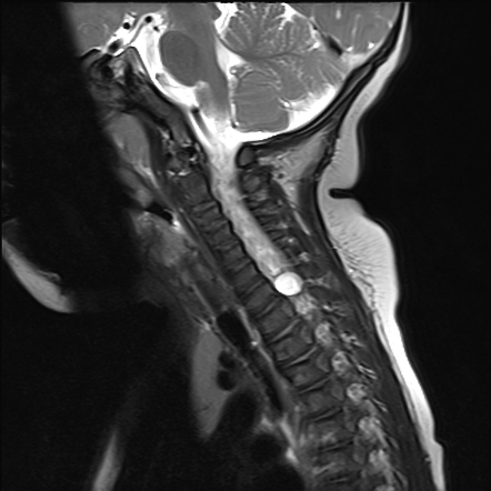 Brachial Plexus Birth Injury 