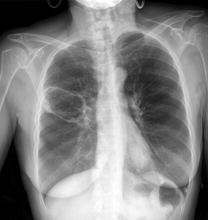 Cystic squamous cell lung cancer | Radiology Case | Radiopaedia.org