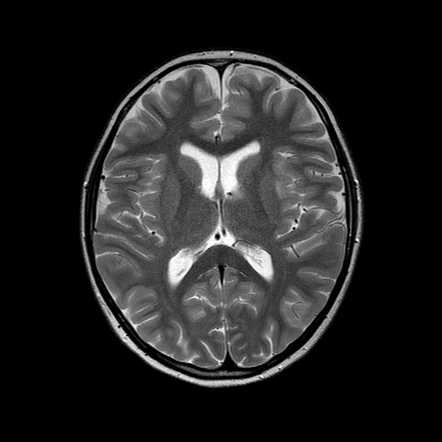 Neuromyelitis optica with anti-NMDA receptor encephalitis | Radiology ...