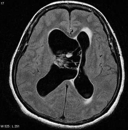 Central Neurocytoma 