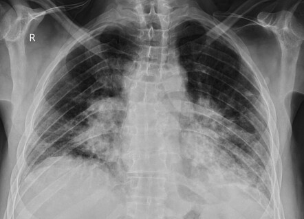 Sarcoidosis | Radiology Case | Radiopaedia.org