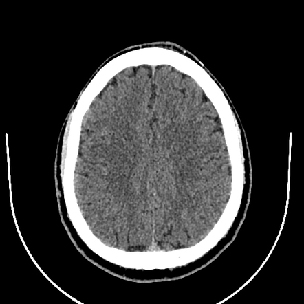 Benign miliary osteoma cutis | Radiology Case | Radiopaedia.org