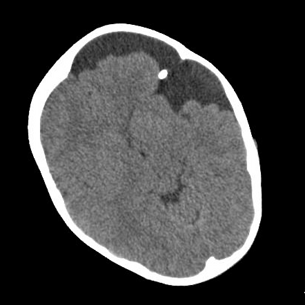 Arachnoid cyst | Radiology Case | Radiopaedia.org