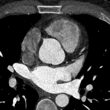 Single left pulmonary vein | Radiology Case | Radiopaedia.org