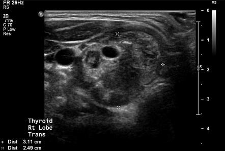 Papillary thyroid carcinoma | Radiology Case | Radiopaedia.org