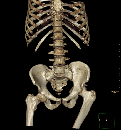 Posterior hip fracture-dislocation with lipohaemarthrosis | Radiology ...