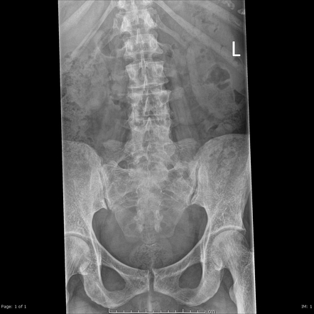 Myelofibrosis Radiology Case Radiopaedia Org