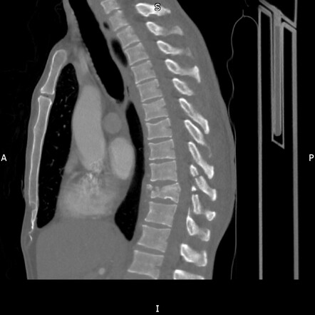 Chance fracture | Radiology Case | Radiopaedia.org