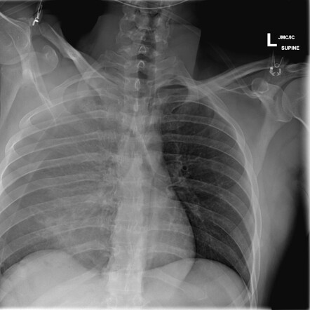 Liver Laceration From Stabbing 