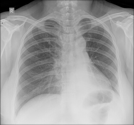 Bronchial carcinoid | Radiology Case | Radiopaedia.org