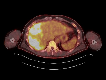 Epithelioid hemangioendothelioma (FDG PET-CT) | Radiology Case ...