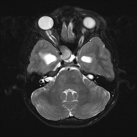 Optic nerve glioma (pilocytic astrocytoma) - neurofibromatosis type 1 ...