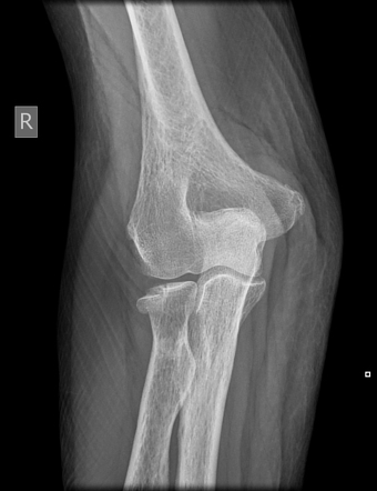 Radial head fracture | Radiology Case | Radiopaedia.org