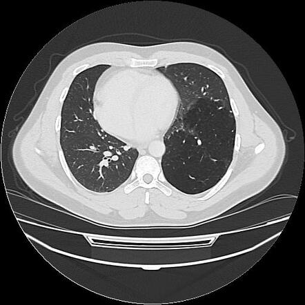 Pulmonary Sequestration - Intralobar 