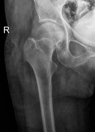 Garden I femoral neck fracture | Radiology Case | Radiopaedia.org