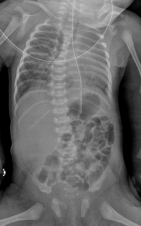 Congenital hiatus hernia | Radiology Case | Radiopaedia.org