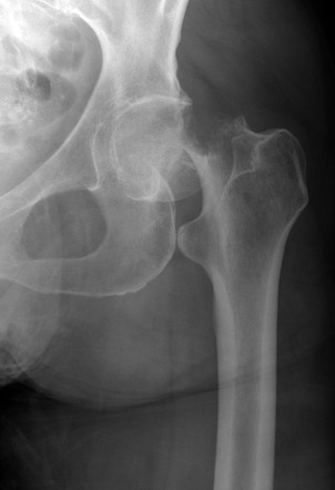 Garden Iv Femoral Neck Fracture 