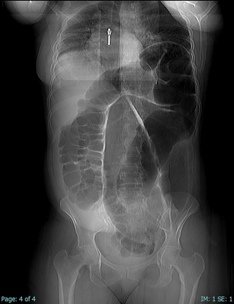 Sigmoid volvulus | Radiology Case | Radiopaedia.org