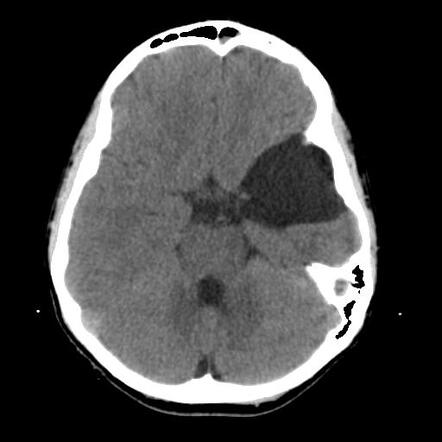 Arachnoid Cyst - Middle Cranial Fossa 