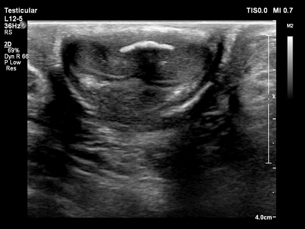 Peyronie disease Radiology Case Radiopaedia