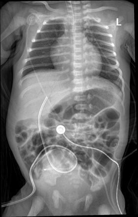 Necrotizing enterocolitis | Radiology Case | Radiopaedia.org