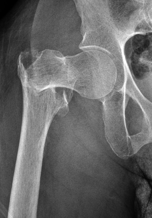 Intertrochanteric fracture | Radiology Case | Radiopaedia.org