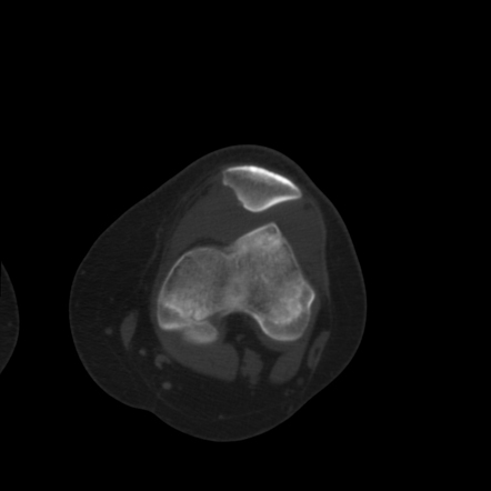 Lateral patellar dislocation with osteochondral injury | Radiology Case ...