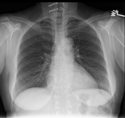 Laminoplasty | Radiology Case | Radiopaedia.org