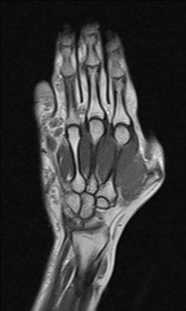 Hand arteriovenous malformation | Image | Radiopaedia.org