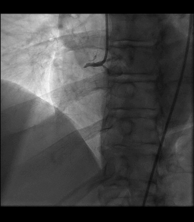 Right coronary artery occlusion successfully treated with percutaneous ...