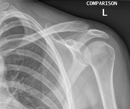 Acromioclavicular Injury 