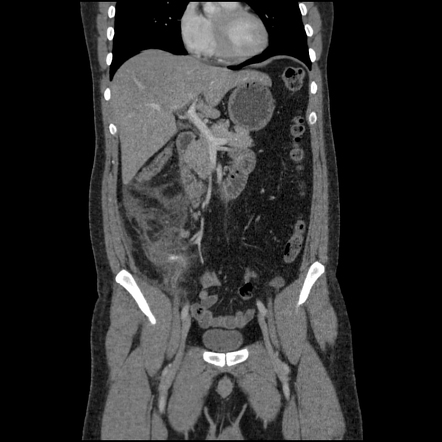 Acute appendicitis with appendicolith | Radiology Case | Radiopaedia.org